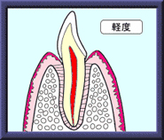 軽度